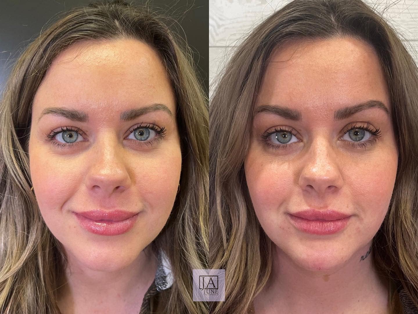 Before After Chin Filler June Aesthetics Before After Chin Filler June Aesthetics